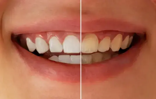 Nahaufnahme eines Mundes mit Zähnen: links deutlich aufgehellt, rechts verfärbt<br />