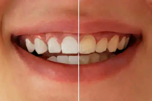 Nahaufnahme eines Mundes mit Zähnen: links deutlich aufgehellt, rechts verfärbt<br />