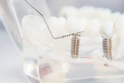 Fester Biss, natürliches Gefühl – mit Zahnimplantaten Modell mit zwei eingesetzten Zahnimplantaten und zahnärztlichem Instrument – anschauliche Darstellung moderner Implantatversorgung in der Zahnarztpraxis Dres. Luhrenberg in Wiesbaden.
