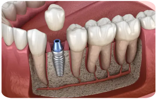 Illustration eines eingesetzten Zahnimplantats im Kieferknochen mit umgebenden Zähnen und Zahnfleisch