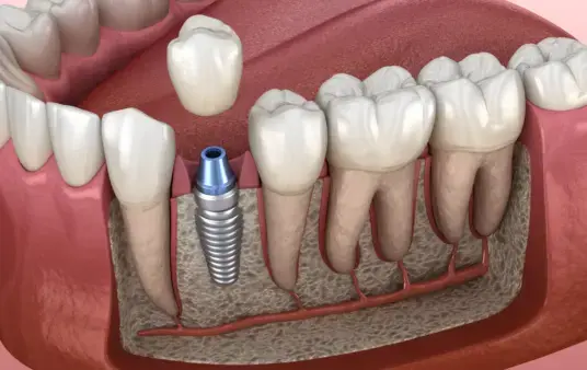 Illustration eines eingesetzten Zahnimplantats im Kieferknochen mit umgebenden Zähnen und Zahnfleisch