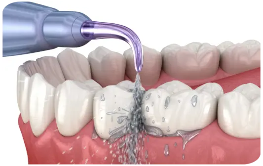 Illustration einer professionellen Zahnreinigung: Ein Wasserstrahl entfernt Zahnstein und Beläge von den Zähnen und dem Zahnfleisch
