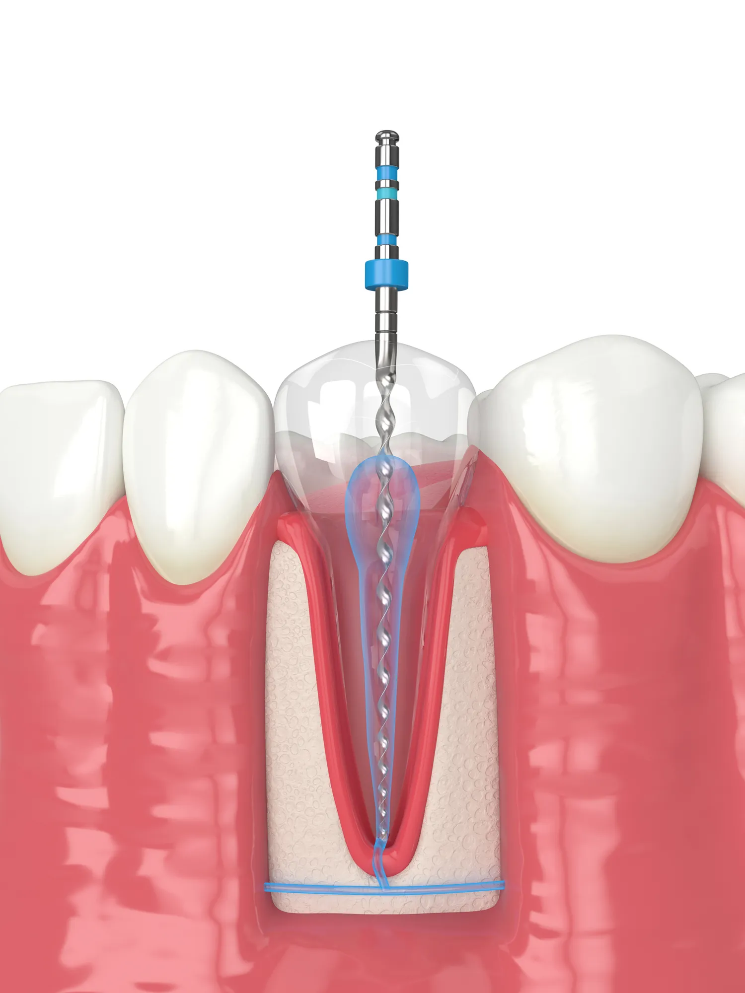 Wurzelkanalbehandlung Wiesbaden – Dres. Luhrenberg Zahnarztpraxis Sanfte Wurzelkanalbehandlung in Wiesbaden bei Dres. Luhrenberg – Zahnerhalt durch moderne Endodontie