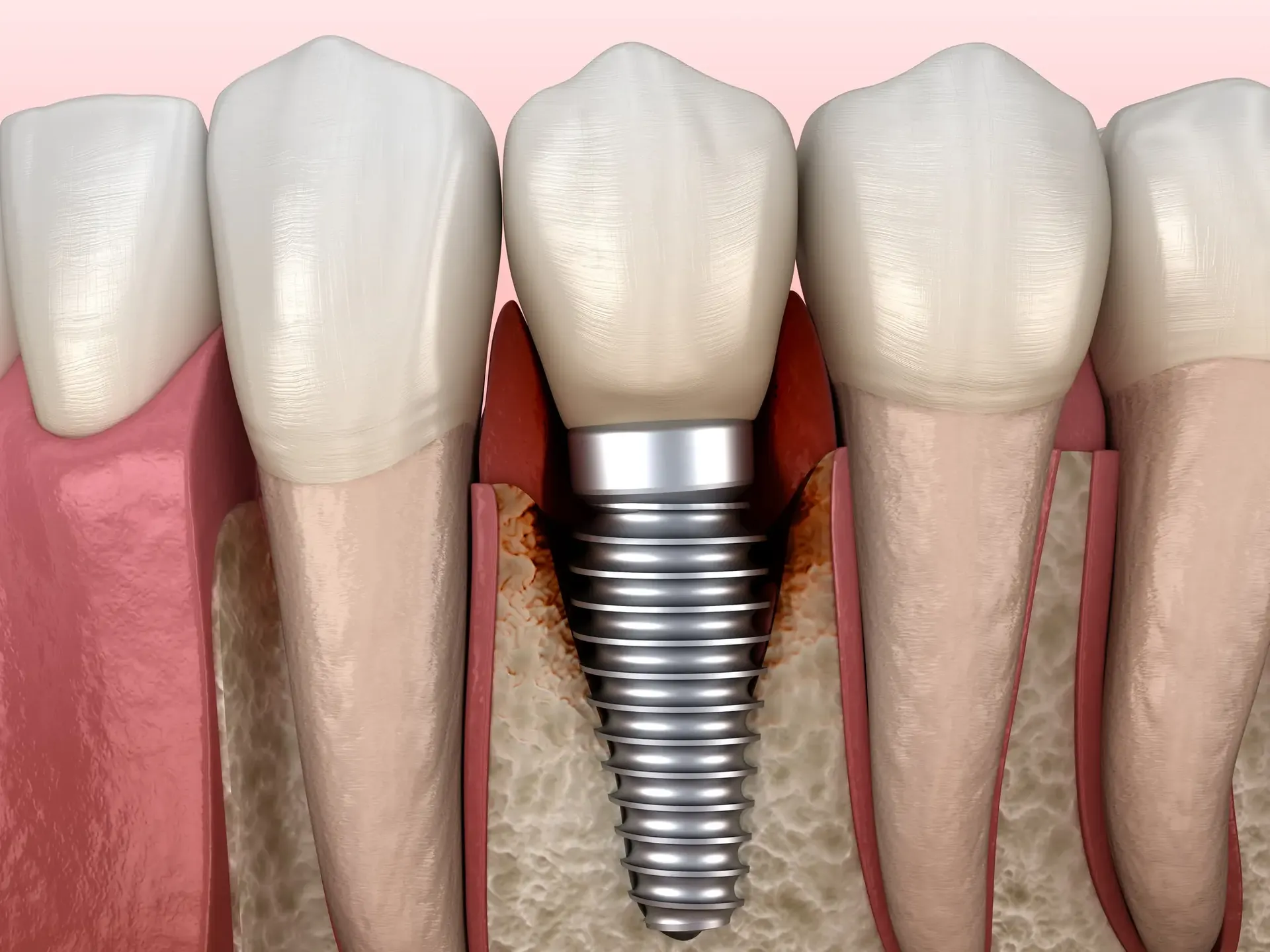 Periimplantitis Behandlung Wiesbaden – Dres. Luhrenberg Zahnarztpraxis Behandlung von Periimplantitis in Wiesbaden bei Dres. Luhrenberg – Therapie für entzündetes Zahnimplantat